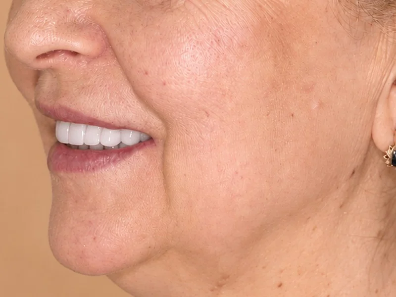 After treatment