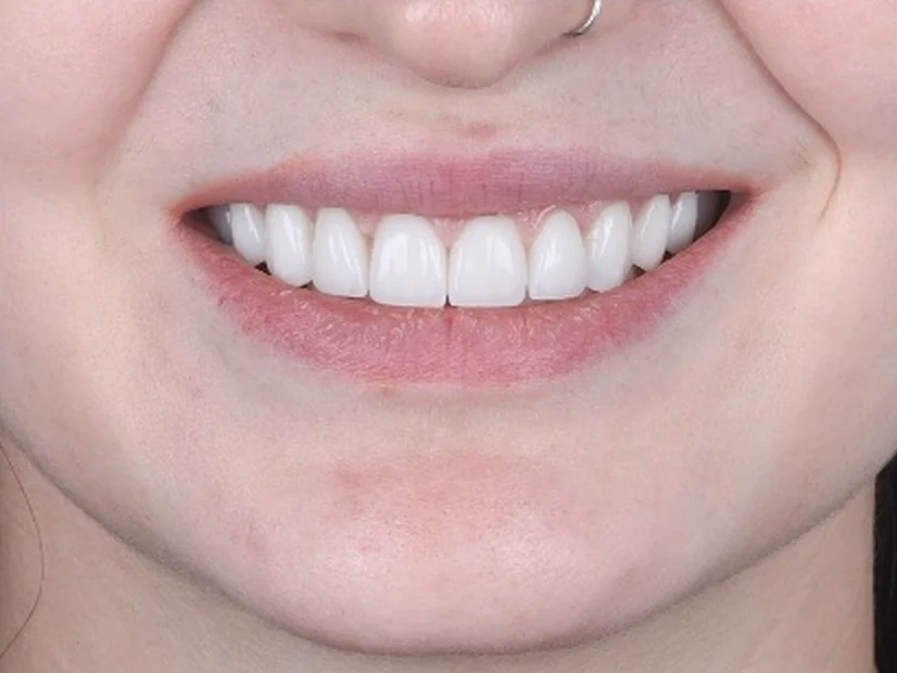 After treatment
