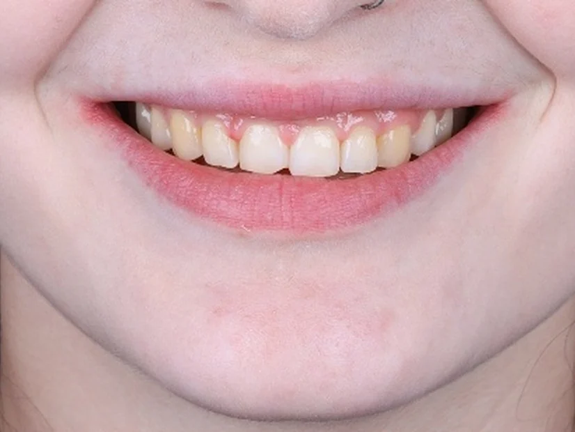 Before treatment