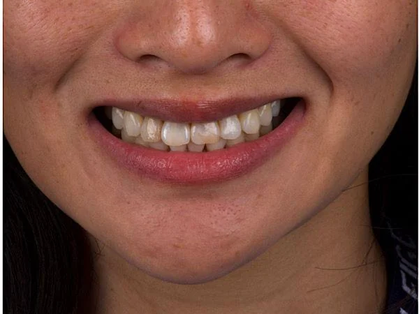 Before treatment