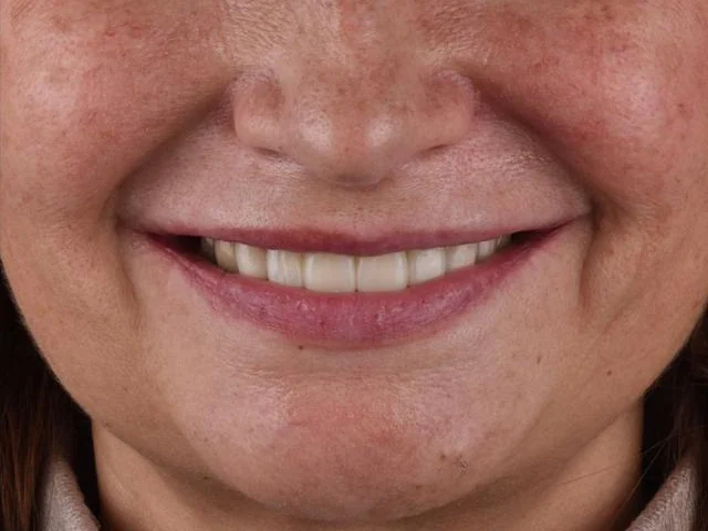 After treatment