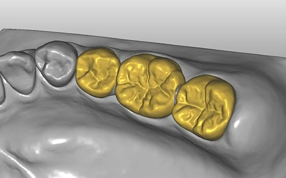 Digital 3D model of the dentition from the scanner